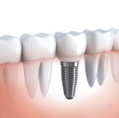 Dental Implant