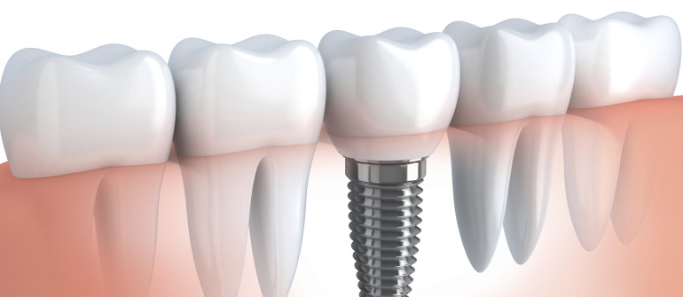 Dental Implant