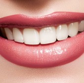 Dental Veneers